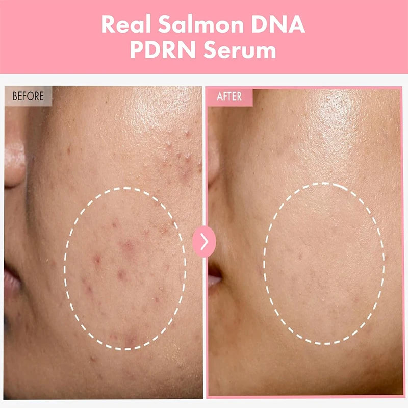 Complex Peptide Acne Serum