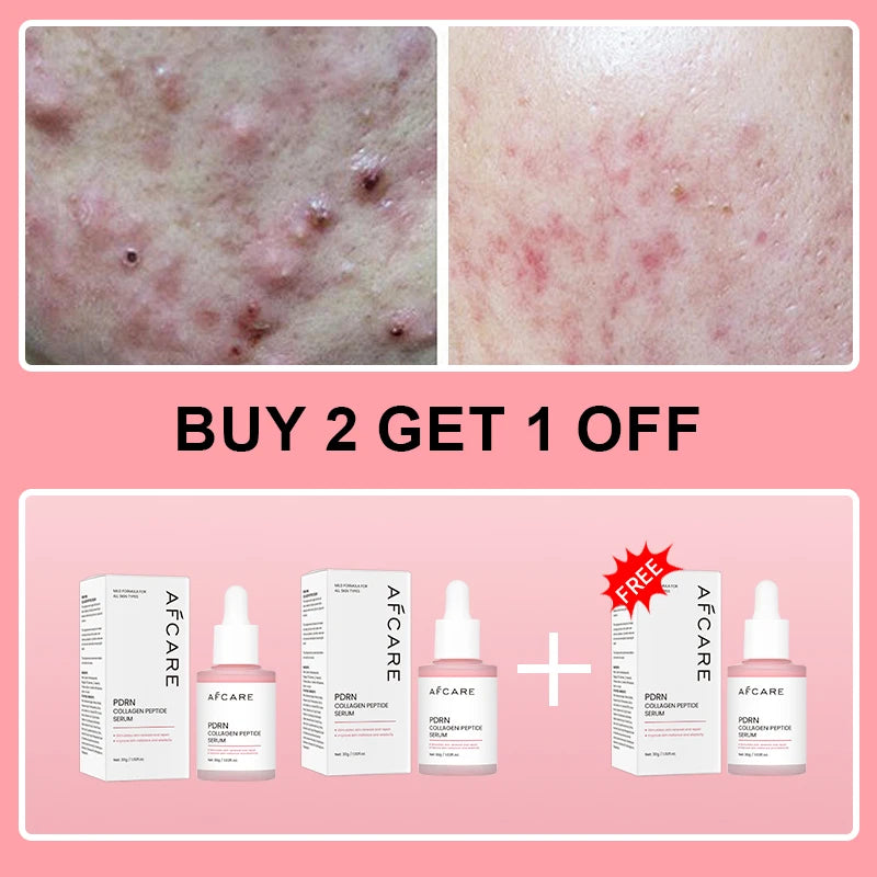 Complex Peptide Acne Serum