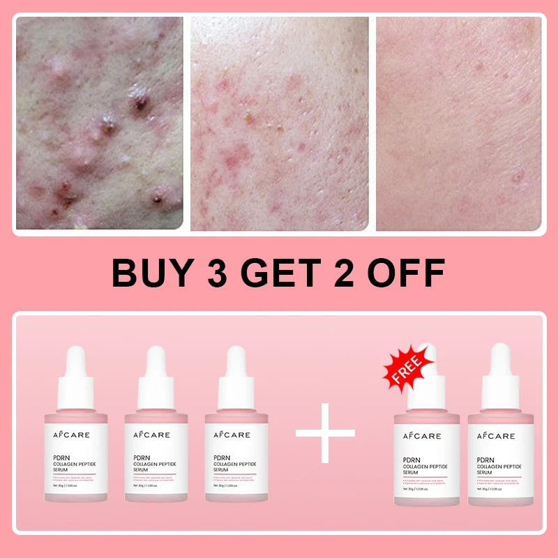Complex Peptide Acne Serum