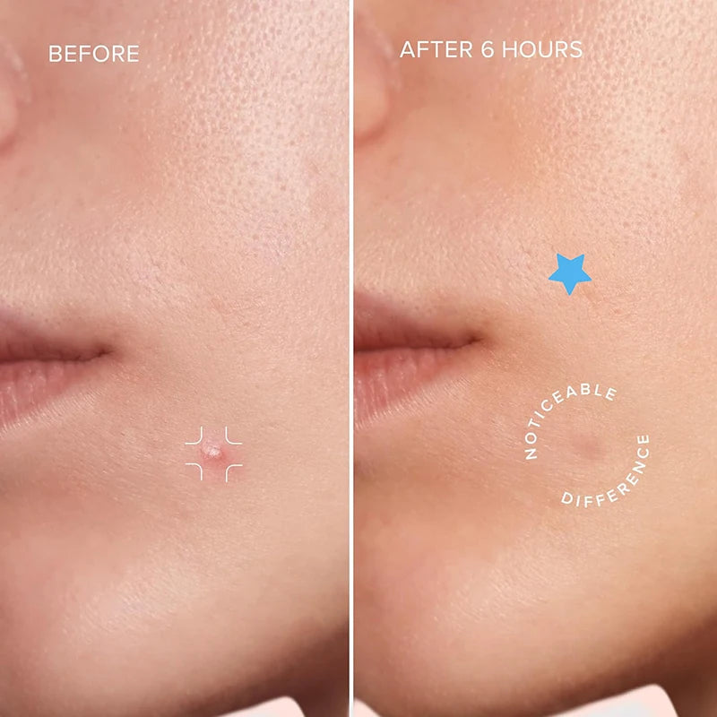 420PCS Star Pimple Patch